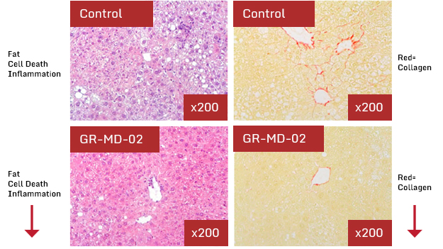 Liver Fibrosis: Fatty liver disease comparison, following treatment with GR-MD-02